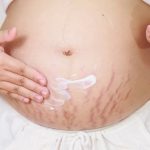 Natural Ingredients' Potential to Remove Stretch Marks