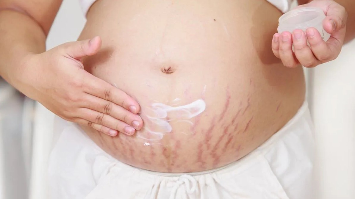 Natural Ingredients' Potential to Remove Stretch Marks